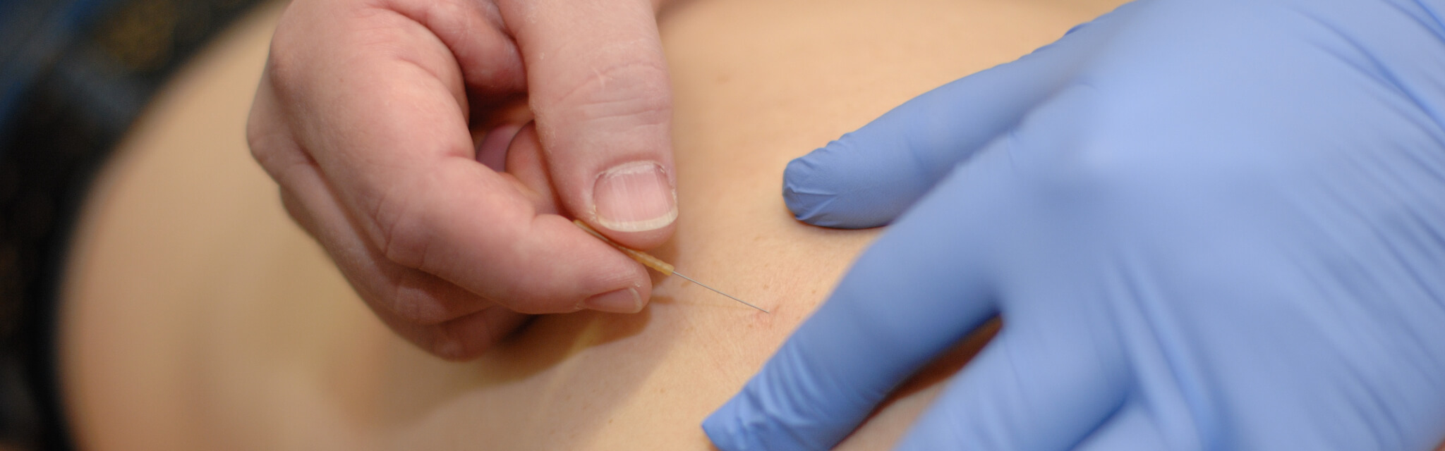 Dry Needling - Behandeling Fysiotherapie bij Fysio 4 Groningen